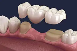 روکش زیرکونیل و PFM