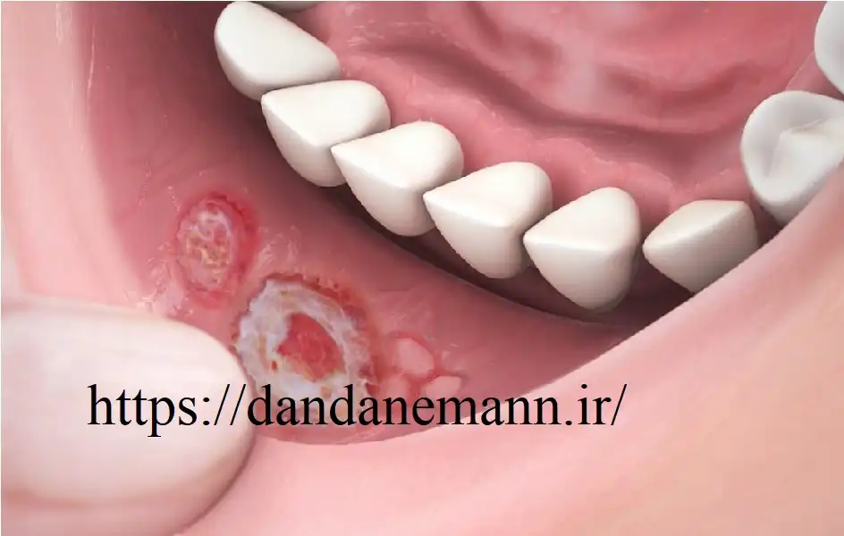 انواع آفت دهان