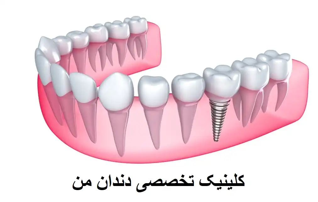 دندان طبیعی و ایمپلنت