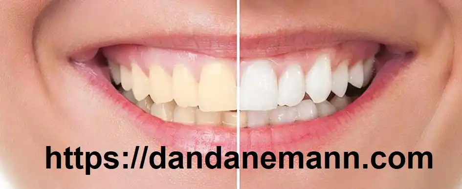 تغییر رنگ کامپوزیت دندان