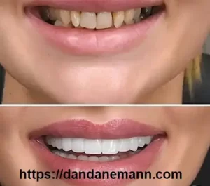 تغییر رنگ کامپوزیت دندان1