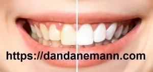 تغییر رنگ کامپوزیت دندان3
