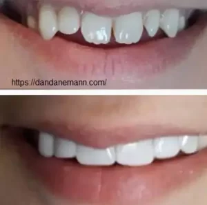 فواید کامپوزیت دندان 
