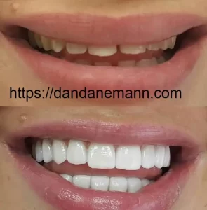 هزینه کامپوزیت دندان در تهران