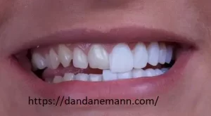 تفاوت کامپوزیت دندان