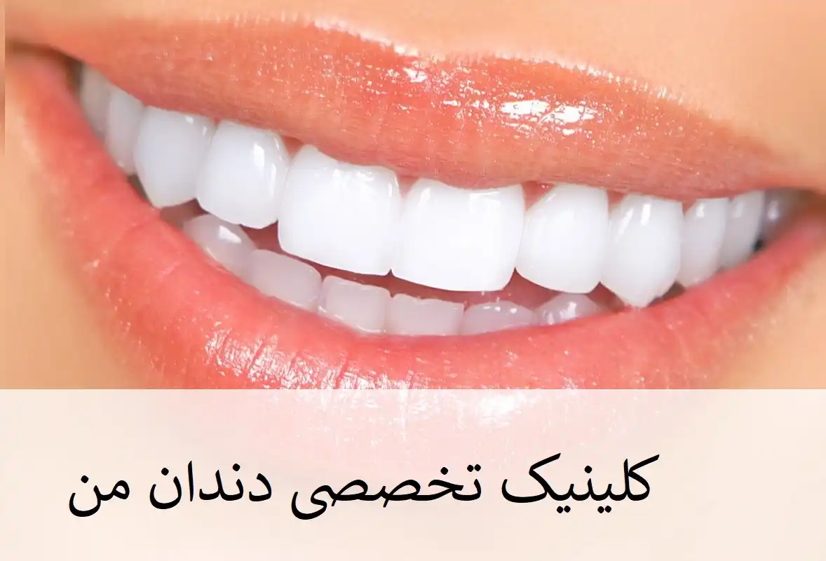 کامپوزیت قسطی دندان در کلاهدوز