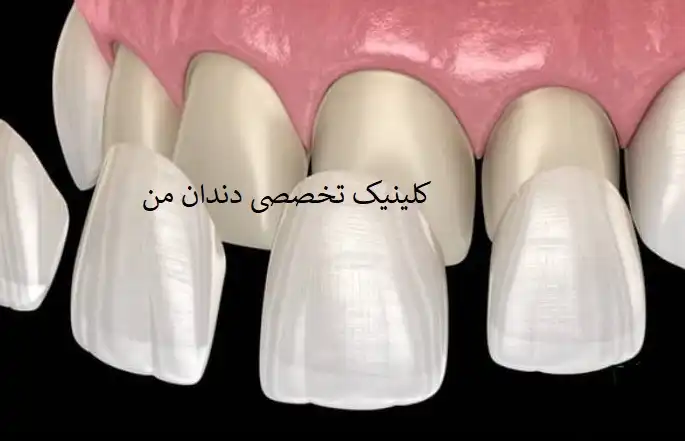 کامپوزیت دندان ونک
