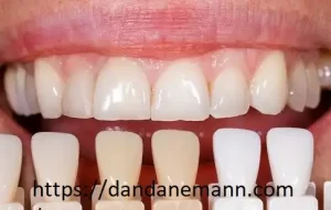 لمینت دندان تهران