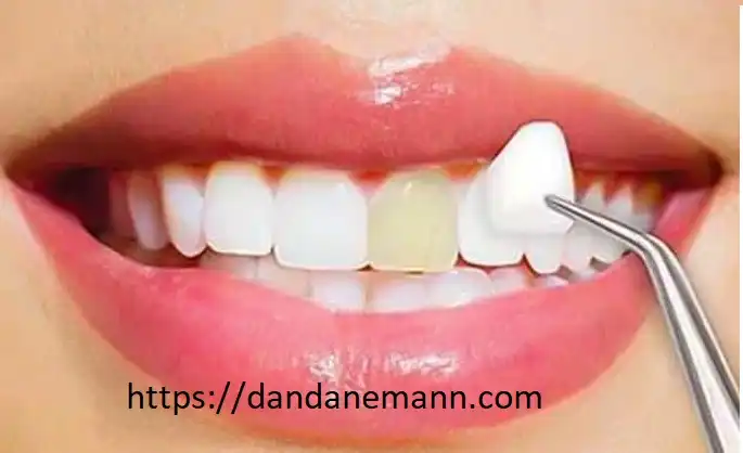 لمینت دندان در تهران